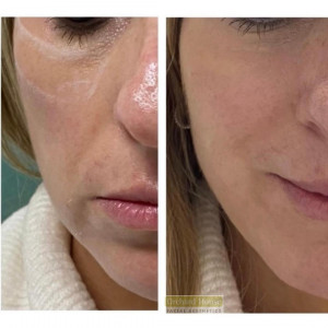 tear trough treatment before and after