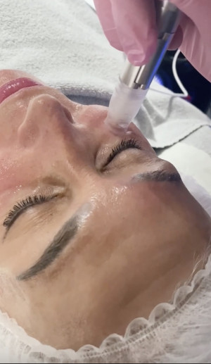 xcellaris twist microneedling eyes