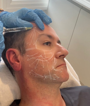 David marked up for LanLuma treatment