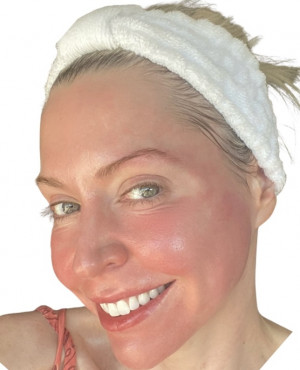 Stephanie face microneedled