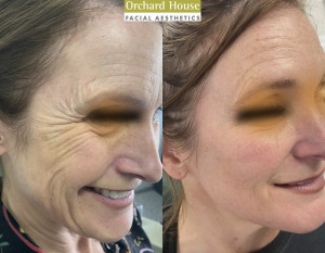 microneedling skin quality results