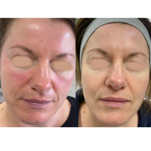 before and after lumecca treatment