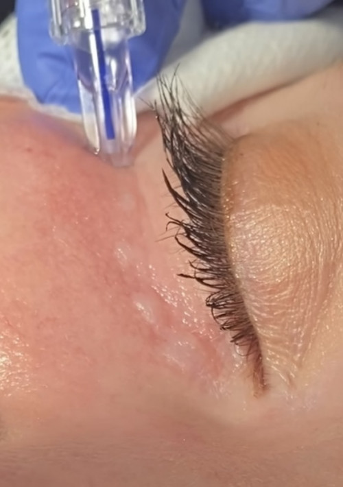 Dr Stephanie receiving polynucleotide injection under eyes