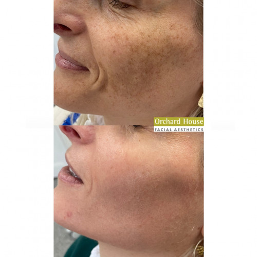 Hyperpigmentation cheek2