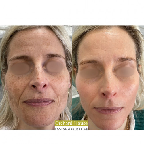 Before and after pigmentation treatment Northallerton