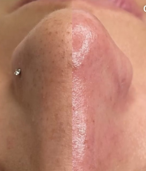 nose blackheads  before and after hydrafacial