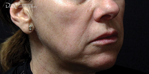 Lanluma Before Image