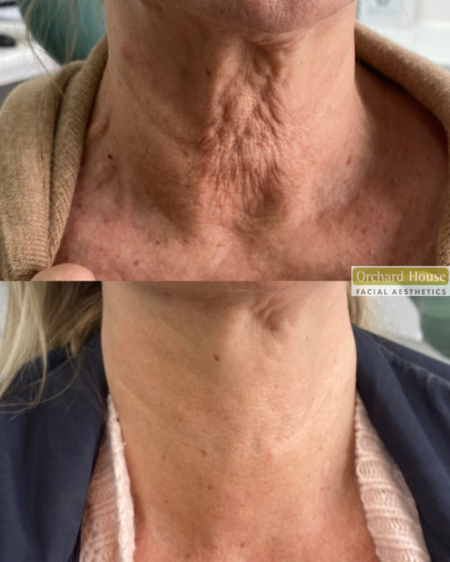 Before and after neck rejuvenation