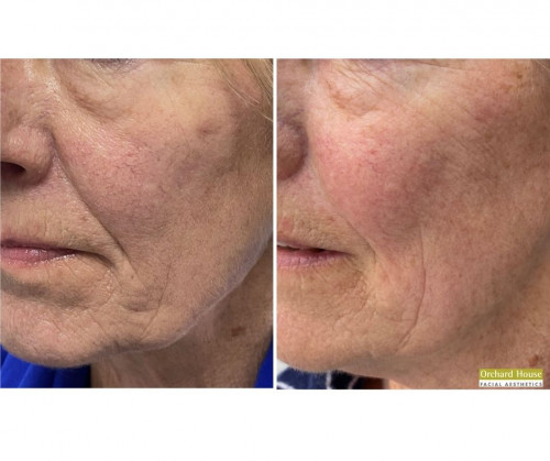 Radiesse by Dr. Stephanie