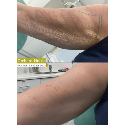 Before and after Radiesse in the arms