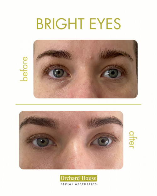 Before and after eye treatment