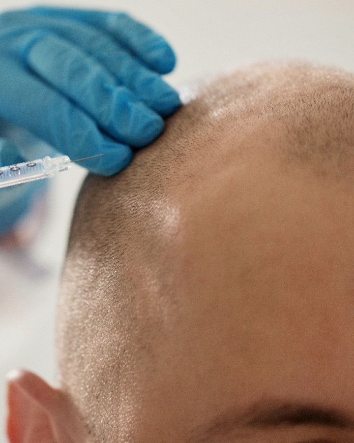 picture of a man getting i-PRF hair treatment at orchard house