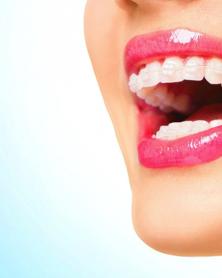 close up picture of a womans smile showing six month smiles clear adult braces on her teeth