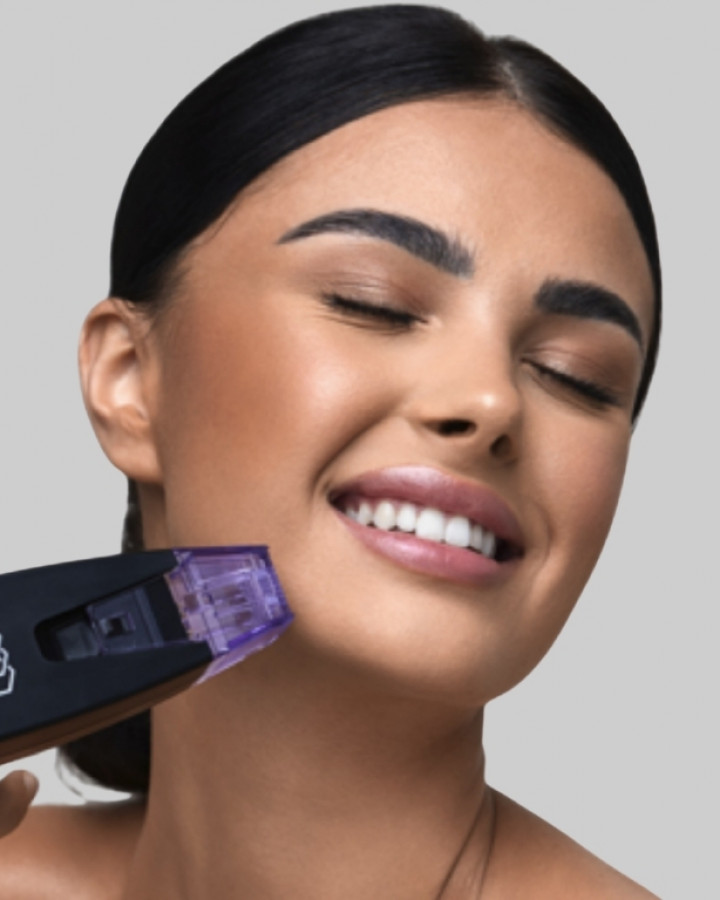 photo of a model getting Morpheus8 treatment