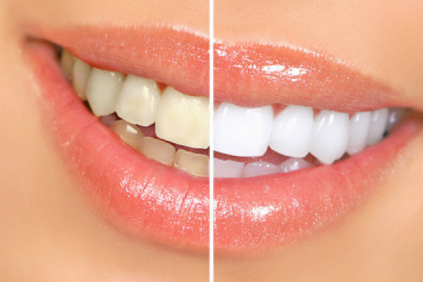 gallery-teeth-whitening-05