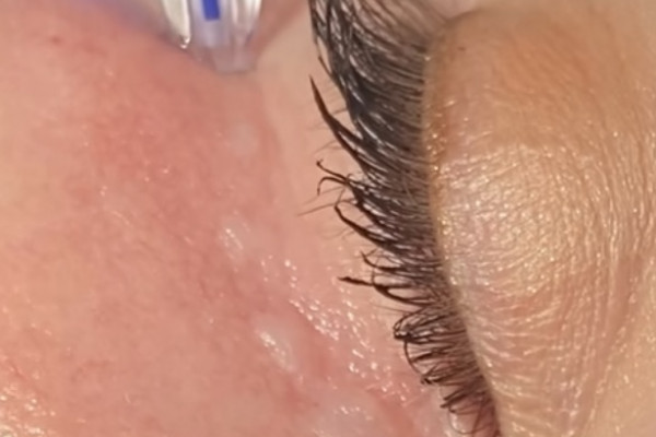 Dr Stephanie receiving polynucleotide injection under eyes