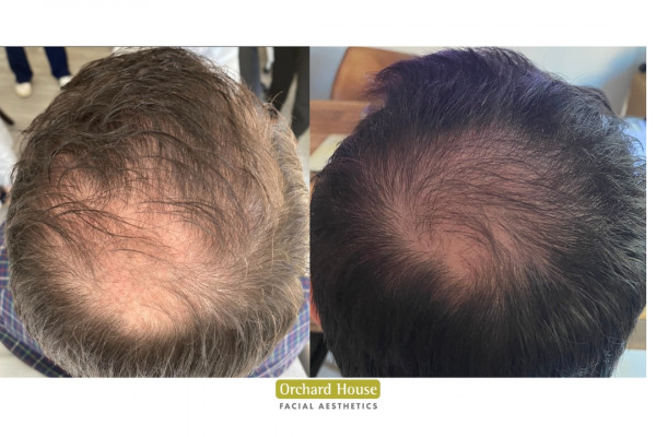 e50 hair loss update