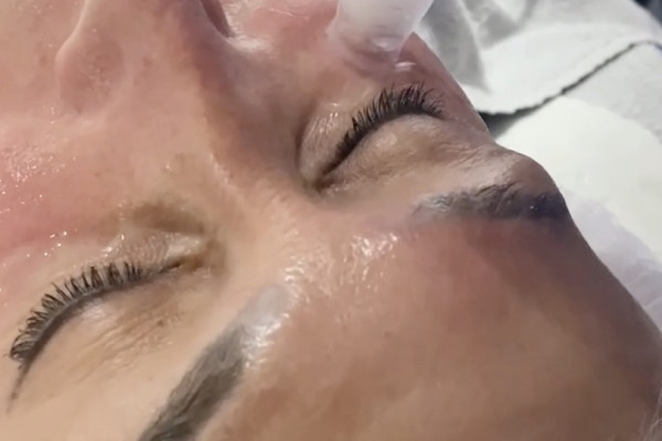 xcellaris twist microneedling around a clients eyes