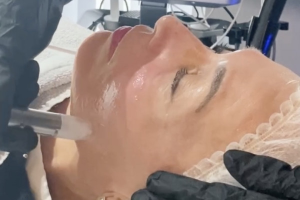 Dr Steph carrying out xcellaris twist microneedling on a client