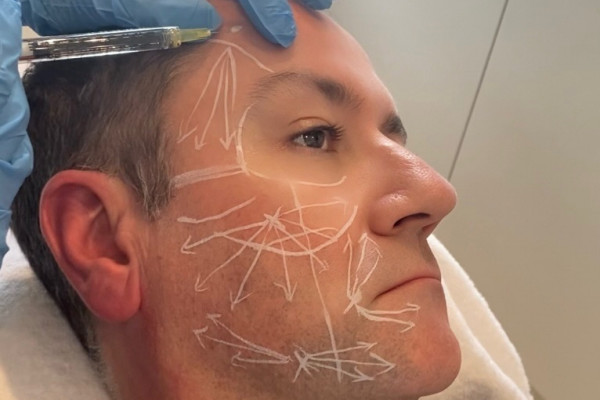 Dr David marked up with an injection pattern for Lanluma treatment