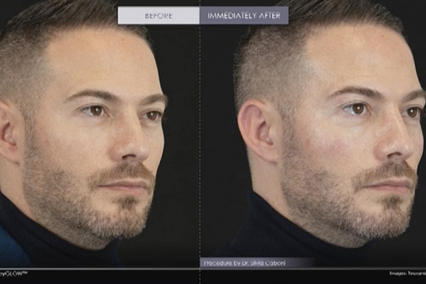 Beforeandafterbabyglowbyteoxaneimagemale
