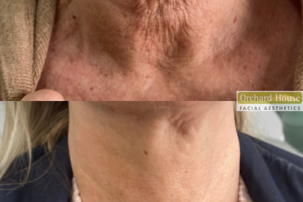 Before and after neck rejuvenation